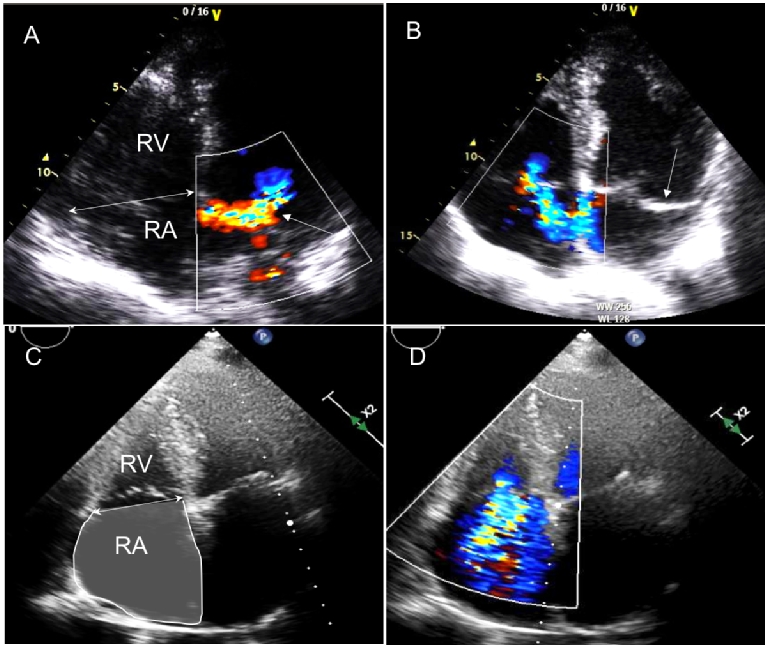 tricuspid-valve-regurgitation-no-longer-the-forgotten-valve